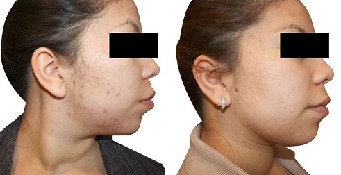 Before and after acne treament